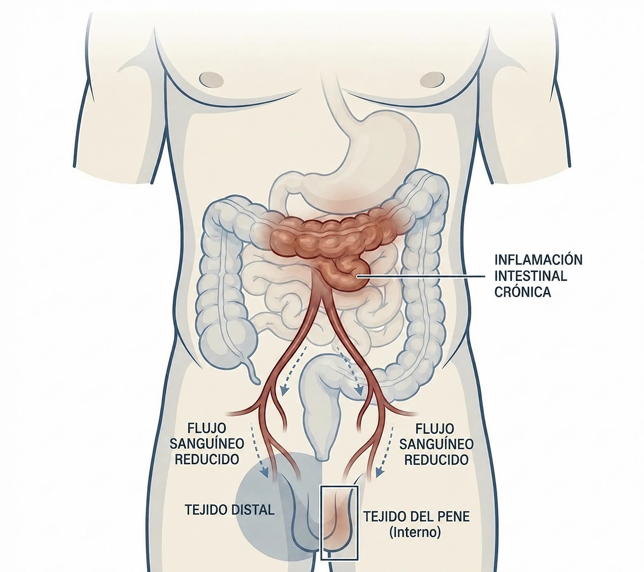 Ilustración de inflamación intestinal y flujo sanguíneo reducido