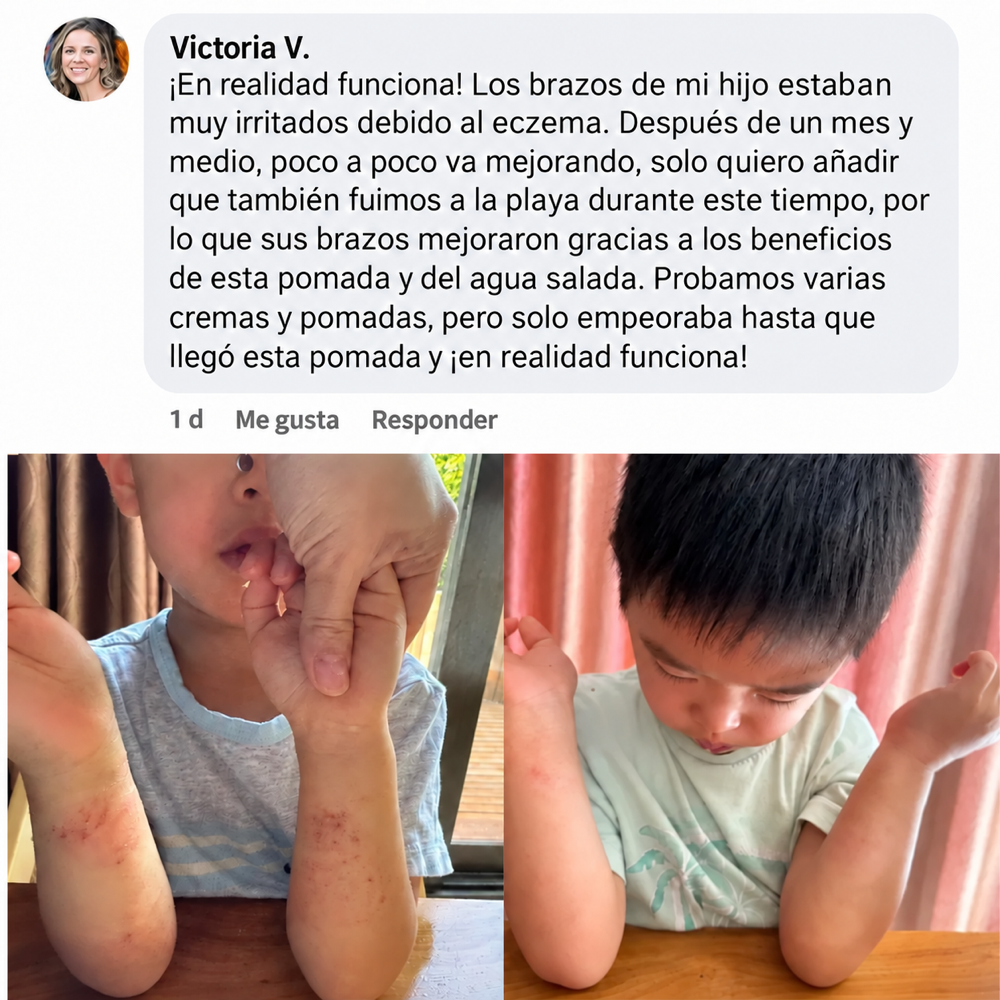 Mella Skin – Crema Para El Eccema