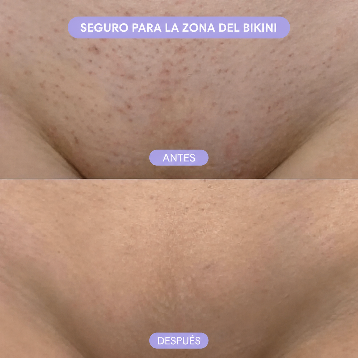 Dermora™ Spray Depilador