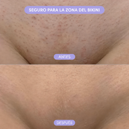 Dermora™ Spray Depilador